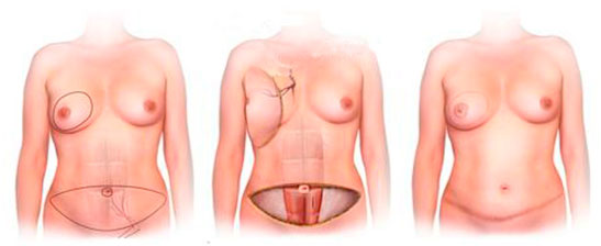 Реконструкция груди | Восстановление молочной железы | Метод DIEP лоскута
