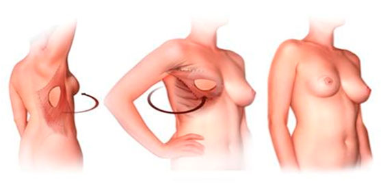 Восстановление молочной железы | Реконструкция груди | LD лоскут