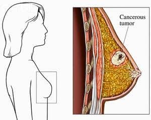 лечение агрессивной формы рака молочной железы в современном маммологическом центре Киева