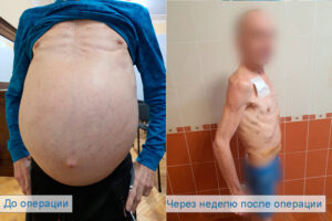 хірургічна операція з видалення заочеревинної саркоми в Київському онкологічному центрі