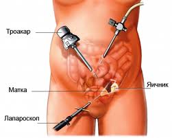 Лапароскопічні операції | лапароскопія | лапароскопія Київ