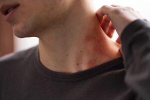 лімфоматозний висип на тілі пацієнта на обстеженні